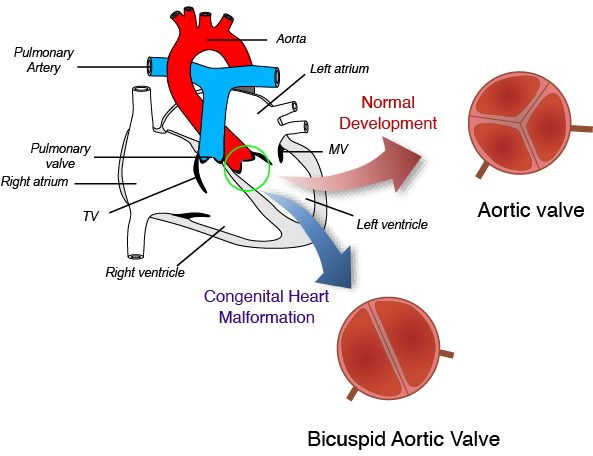 Bicuspid Aortic Valve